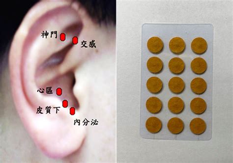 耳穴貼是什麼|耳穴療法